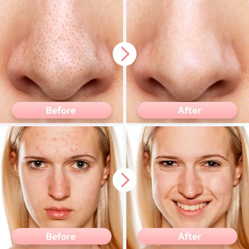Blackhead Remover Pore Vacuum Electric Comedone Extractor Tool with 5 Suction Power and 5 Probes O630