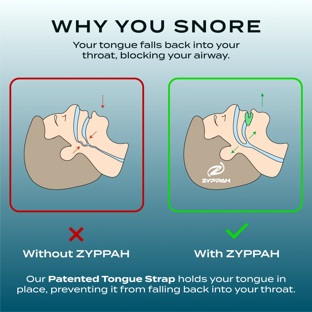 Anti Snoring Hybrid Oral Appliance F6238