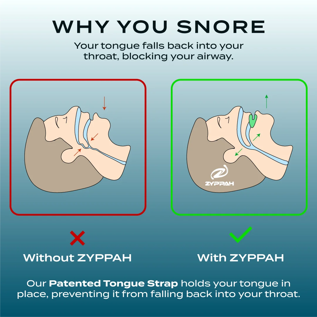 Anti Snoring Hybrid Oral Appliance F6238